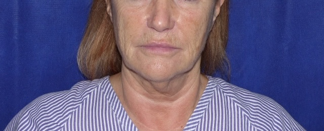 AS FLNL Face Lift Front Before AS FLNL Face Lift Front Before