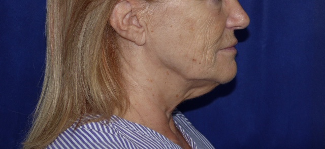 AS FLNL Face Lift Side Before AS FLNL Face Lift Side Before