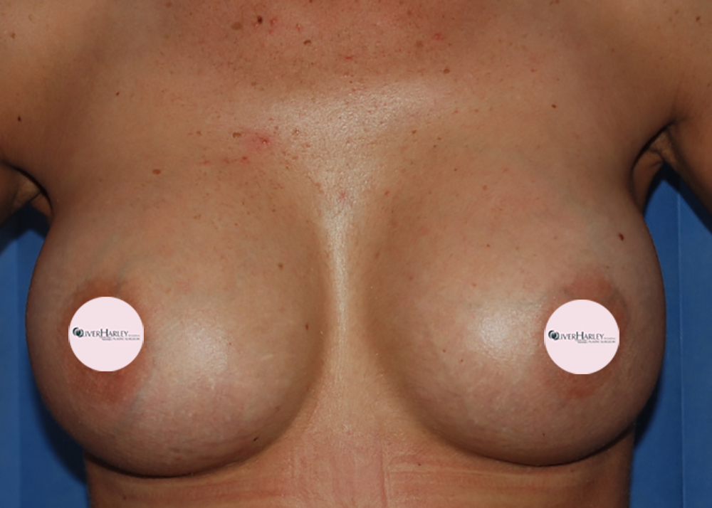 Breast Implant Exchange After