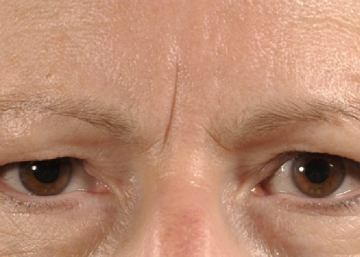 Brow Lift After Brow Lift After