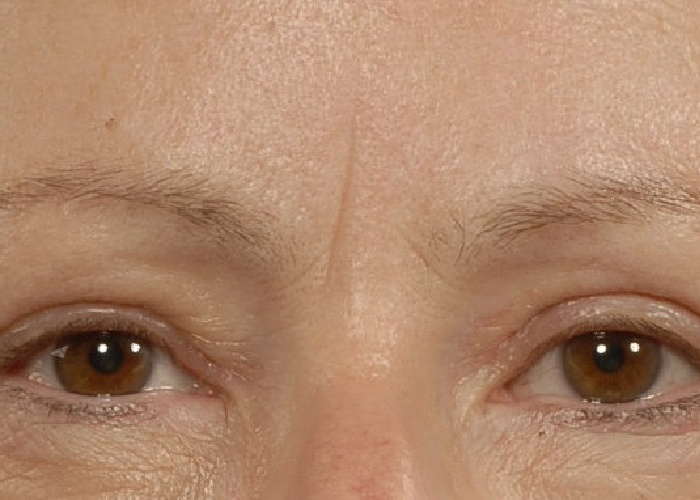Brow Lift Before Brow Lift Before