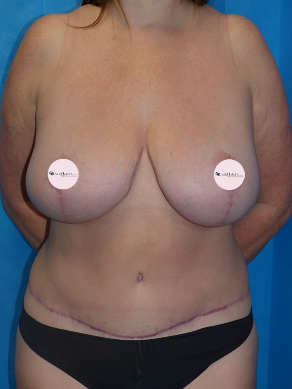CA BBR Breast Reduction Front After