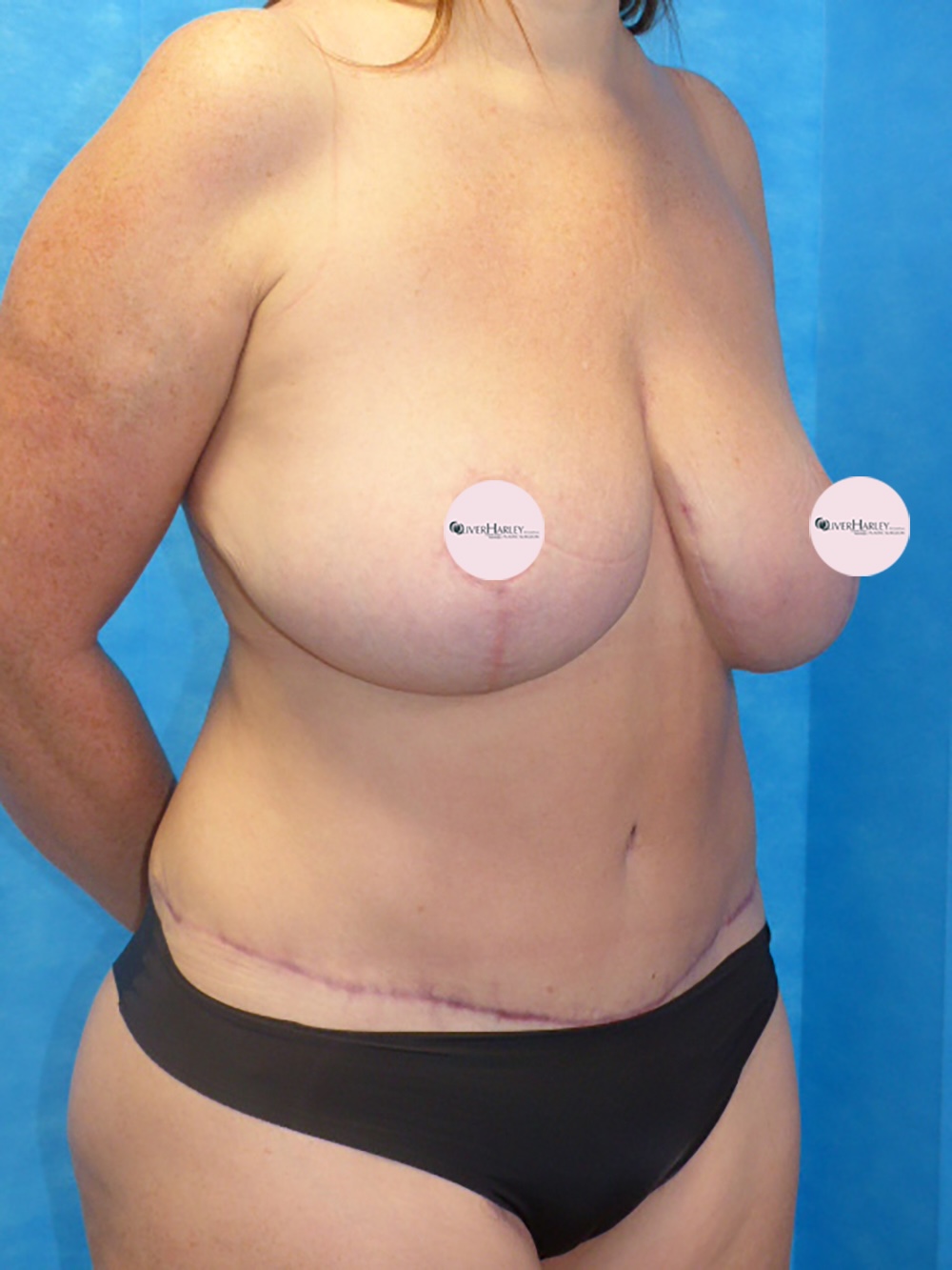 CA BBR Breast Reduction Side After