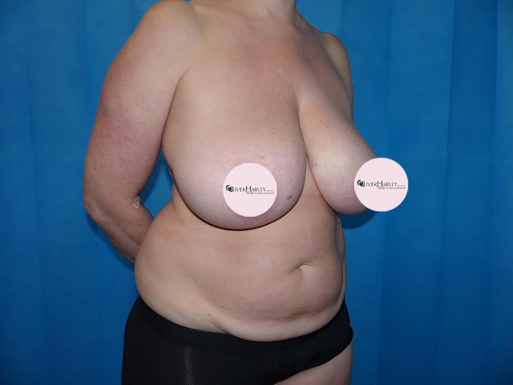 CA BBR Breast Reduction Side Before