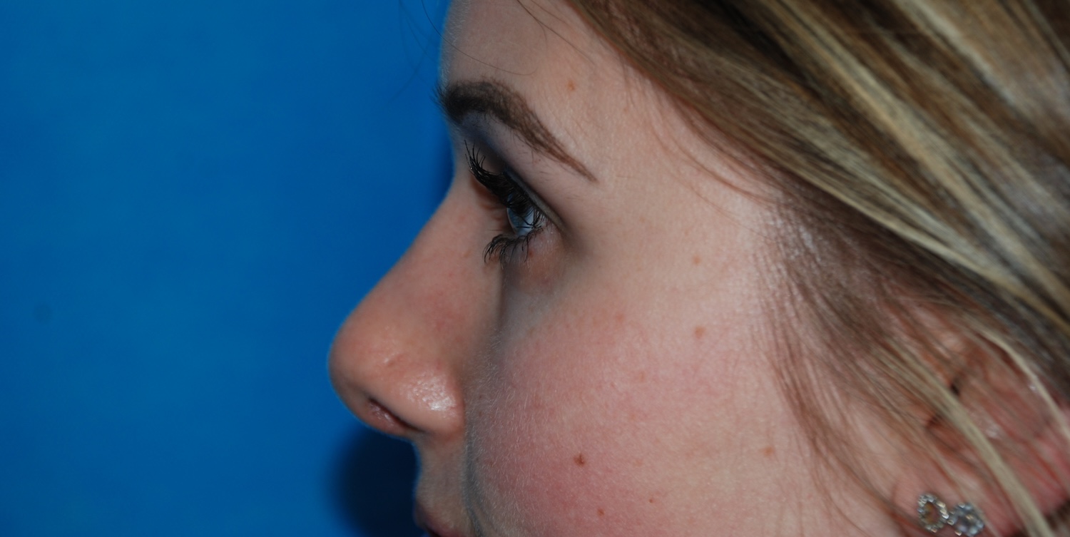 CD Rhinoplasty After CD Rhinoplasty After