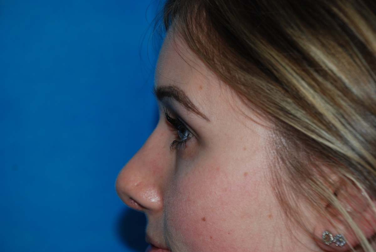 CD Rhinoplasty After