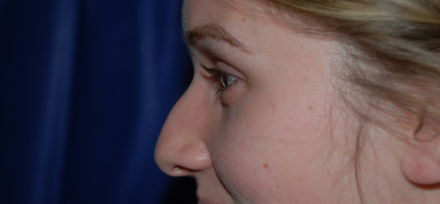 CD Rhinoplasty Before CD Rhinoplasty Before