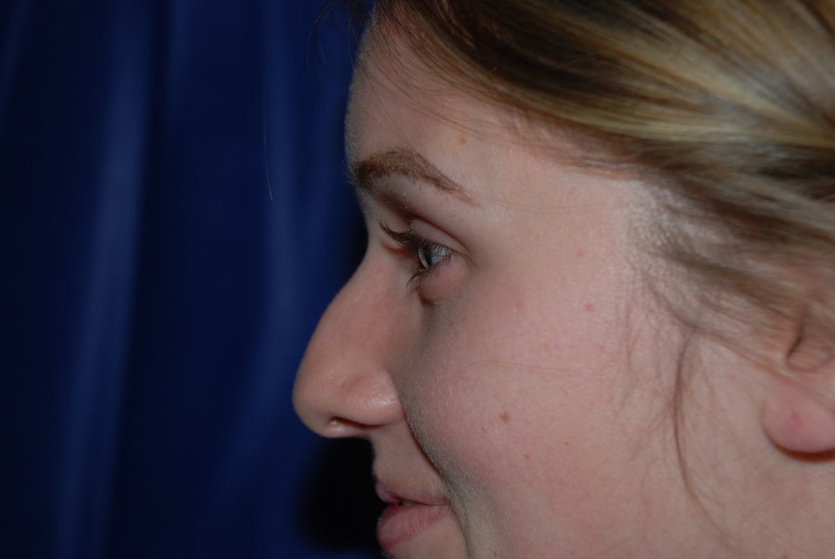 CD Rhinoplasty Before