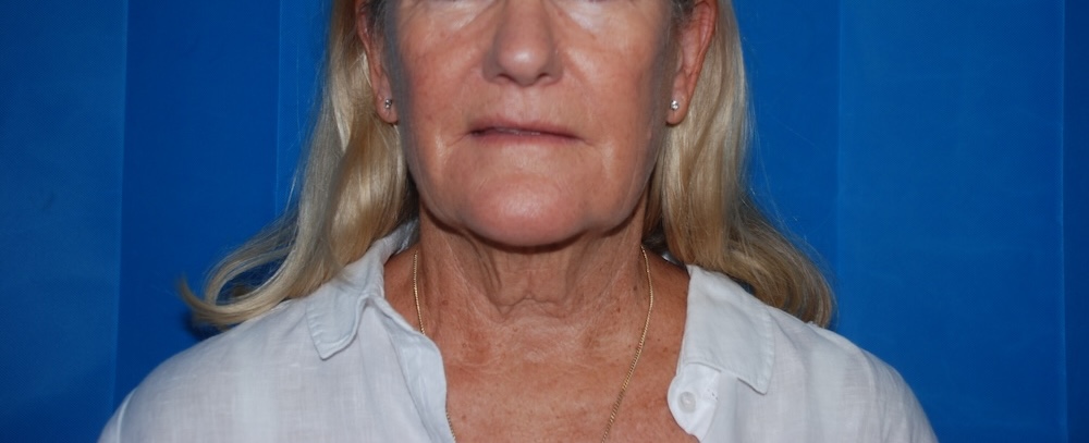 CK FLNL Face Lift Front Before CK FLNL Face Lift Front Before