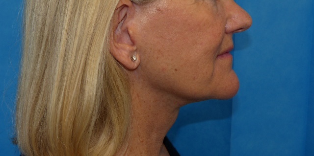 CK FLNL Face Lift Side After CK FLNL Face Lift Side After