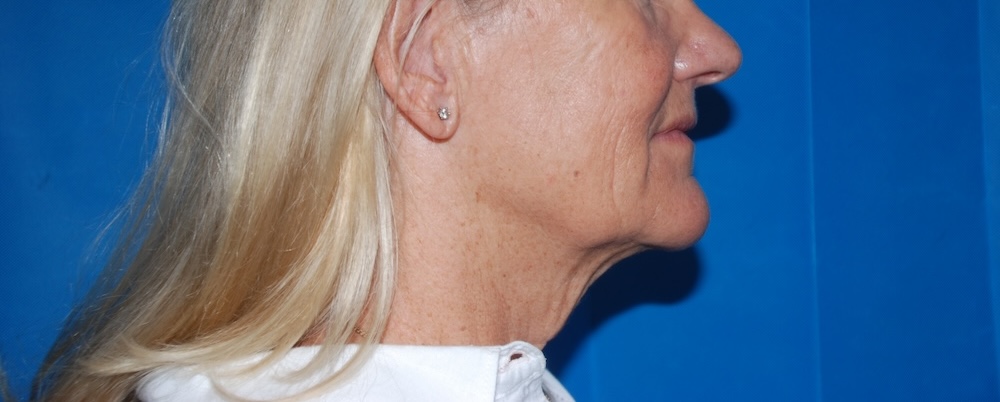 CK FLNL Face Lift Side Before CK FLNL Face Lift Side Before