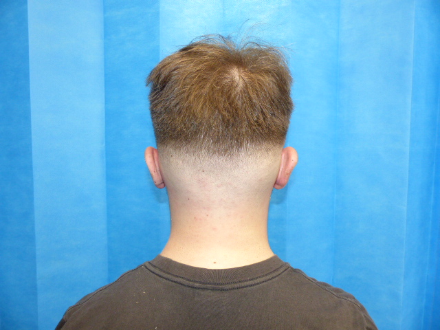 CN Pinner Ear Correction Back After CN Pinner Ear Correction Back After