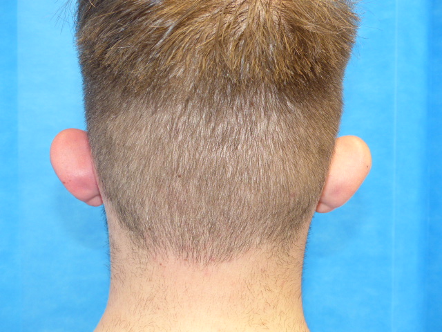 CN Pinner Ear Correction Back Before CN Pinner Ear Correction Back Before