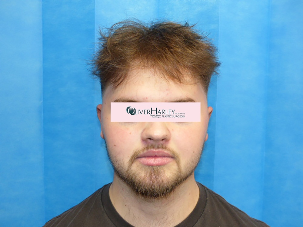 CN Pinner Ear Correction Front After CN Pinner Ear Correction Front After