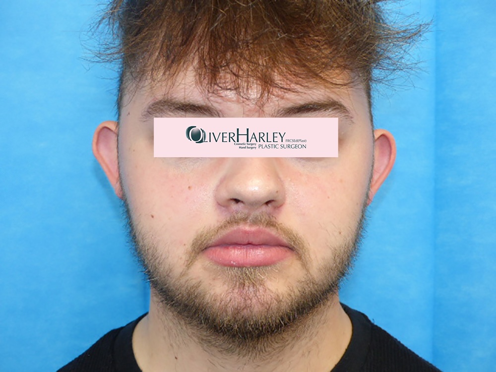 CN Pinner Ear Correction Front Before CN Pinner Ear Correction Front Before