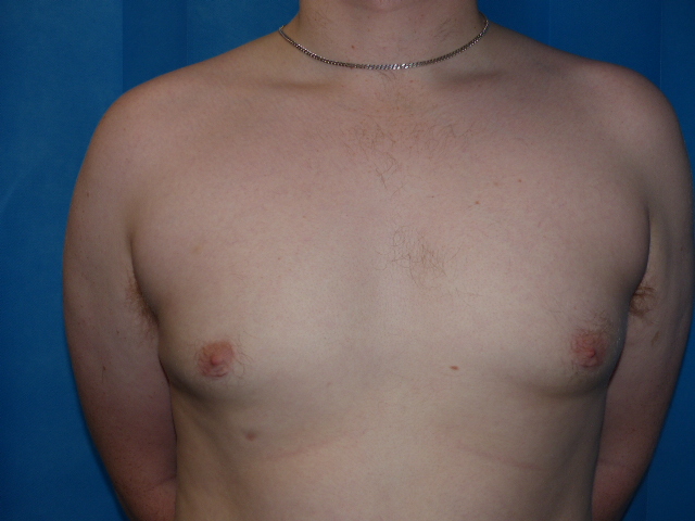 DB GYN Gynaecomastia Front After