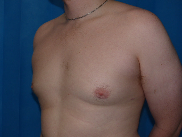 DB GYN Gynaecomastia Side After