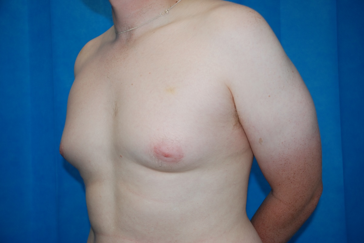 DB GYN Gynaecomastia Side Before