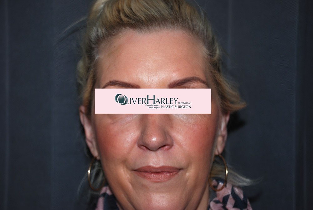 DW Pinner Ear Correction After DW Pinner Ear Correction After