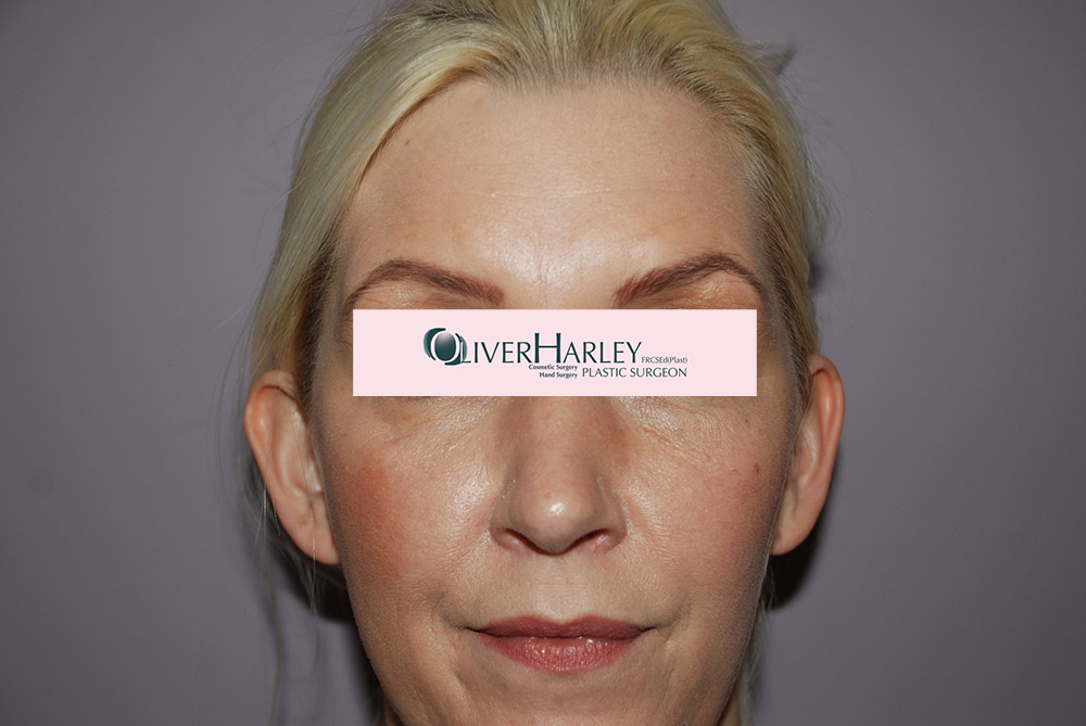 DW Pinner Ear Correction Before DW Pinner Ear Correction Before