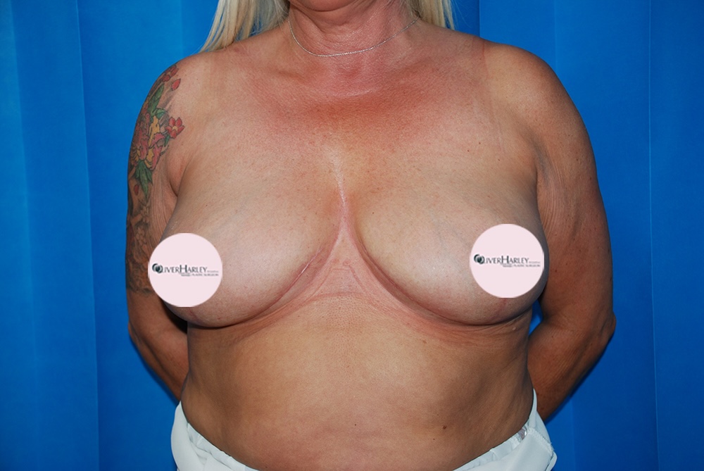 EW BBR Breast Reduction After