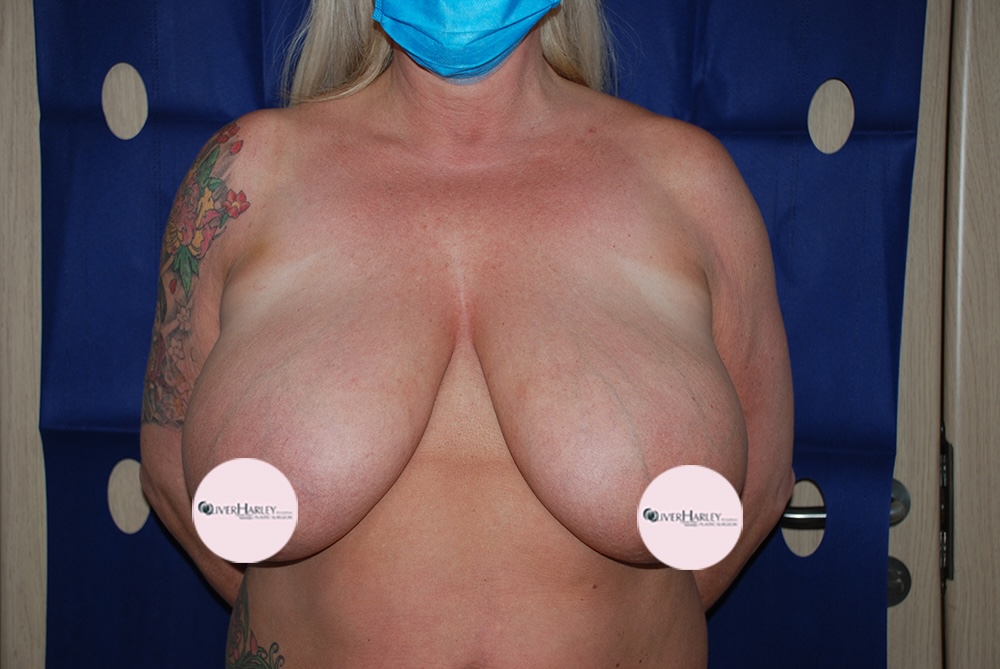 EW BBR Breast Reduction Before