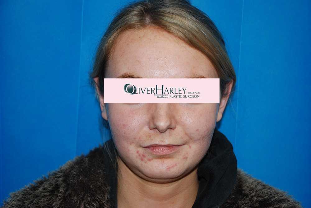 EW Pinna Ear Correction After EW Pinna Ear Correction After