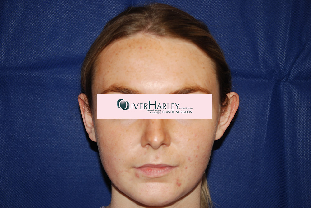 EW Pinna Ear Correction Before EW Pinna Ear Correction Before