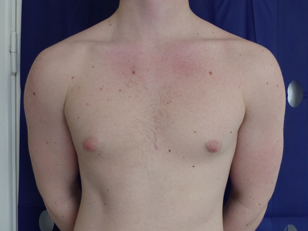GH Gynaecomastia Front Before