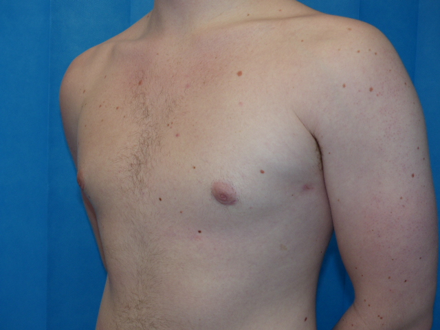 GH Gynaecomastia Side After