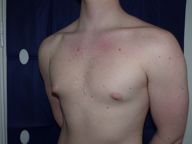 GH Gynaecomastia Side Before