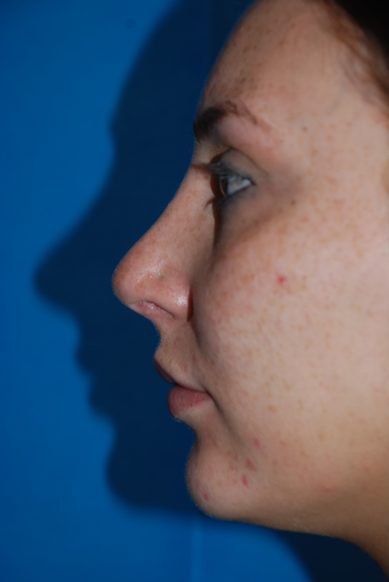 GT Rhino Nose Job After