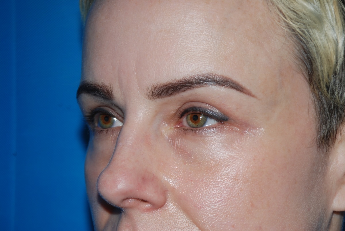 HC Upper Eyelid Side After HC Upper Eyelid Side After