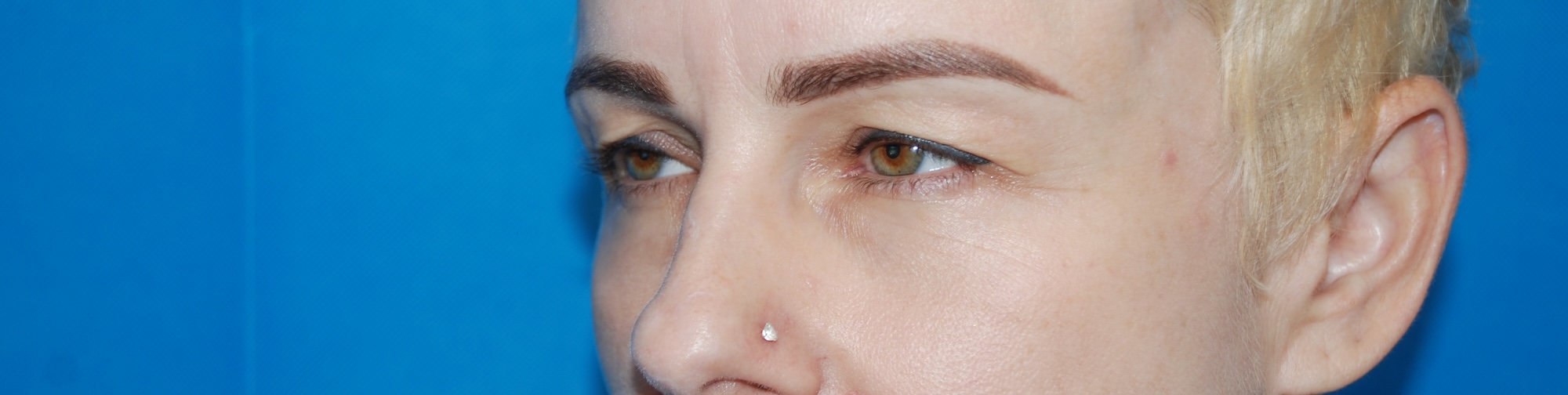 HC Upper Eyelid Side Before HC Upper Eyelid Side Before