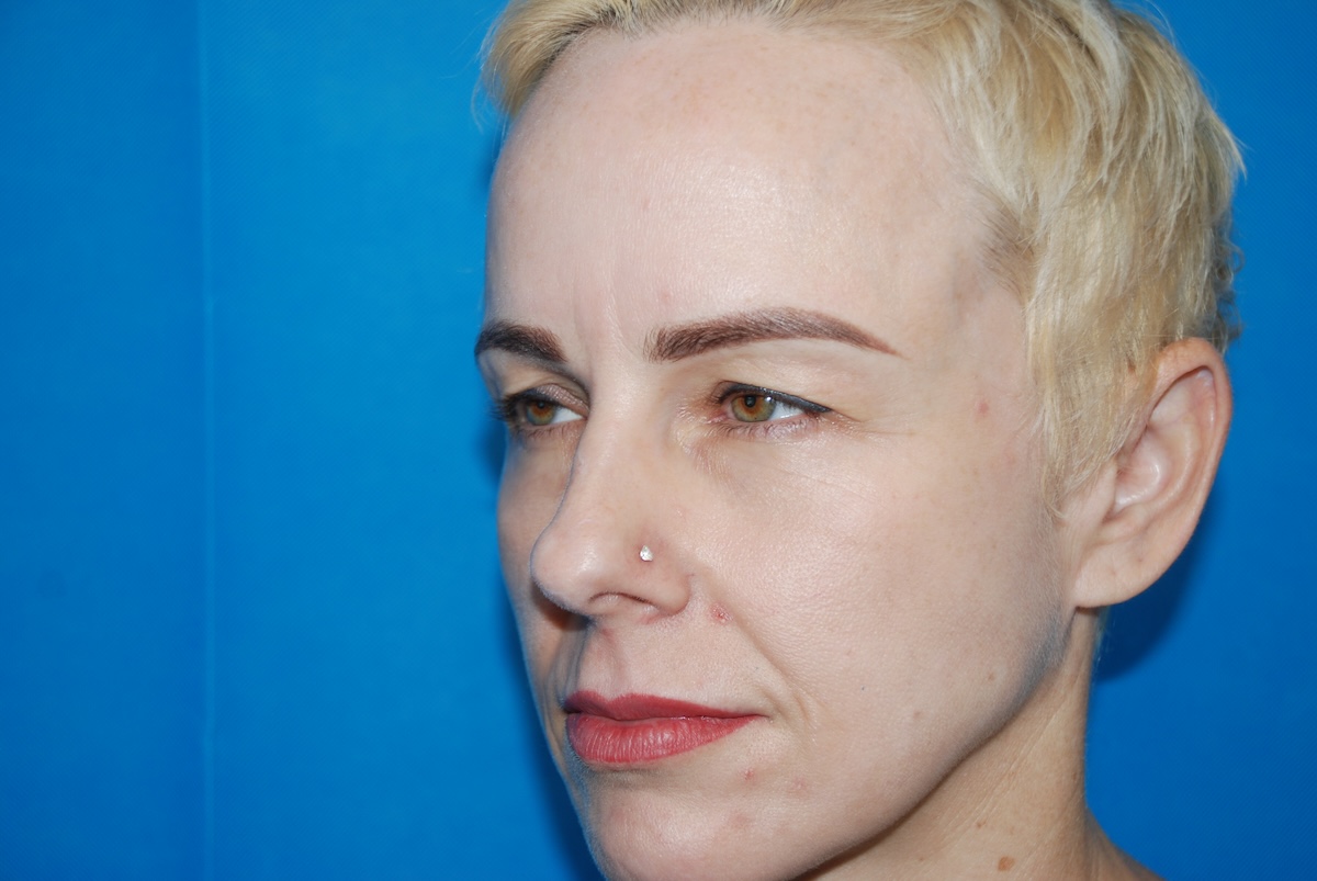 HC Upper Eyelid Side Before