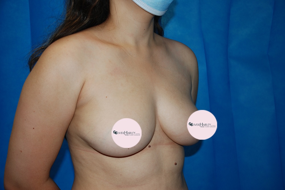 HVW BBA 450 Before Side