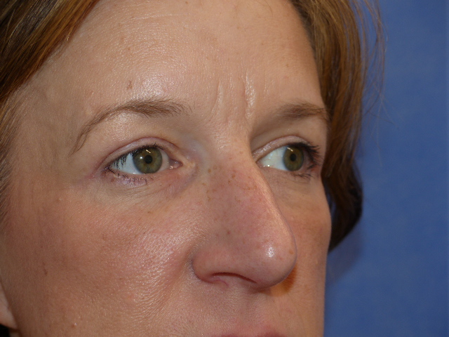 JCarn Upper Eyelid Side After JCarn Upper Eyelid Side After
