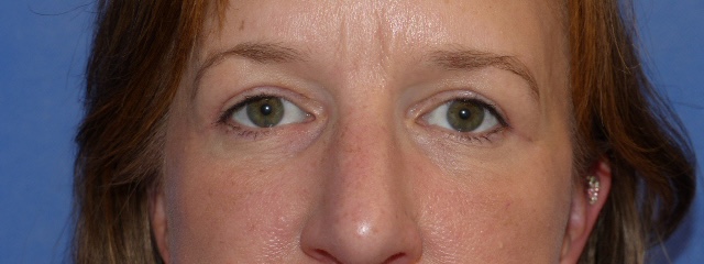 JCarn Upper Eyelid Front After JCarn Upper Eyelid Front After