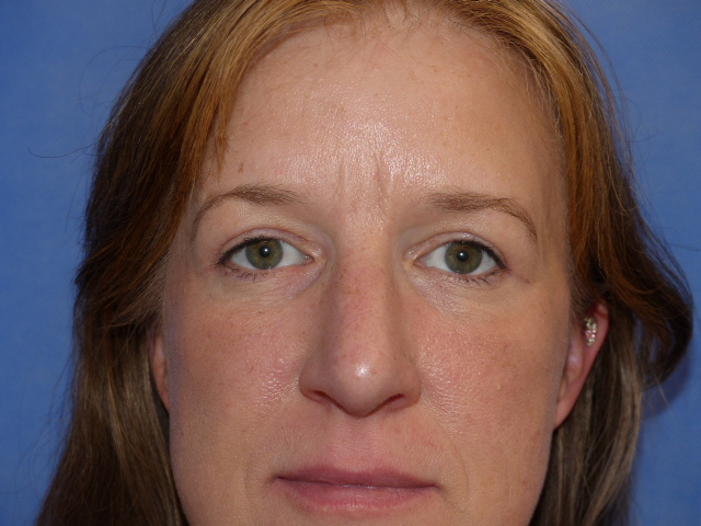 JCarn Upper Eyelid Front After