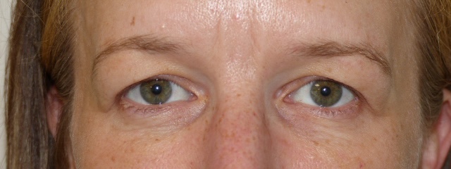 JCarn Upper Eyelid Front Before JCarn Upper Eyelid Front Before