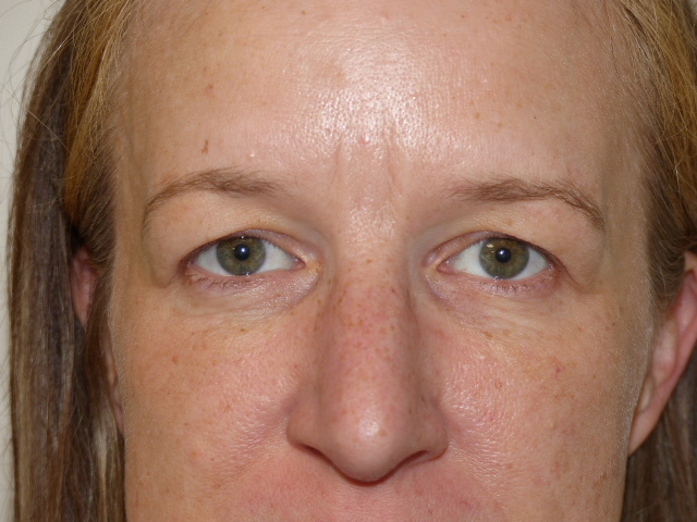 JCarn Upper Eyelid Front Before