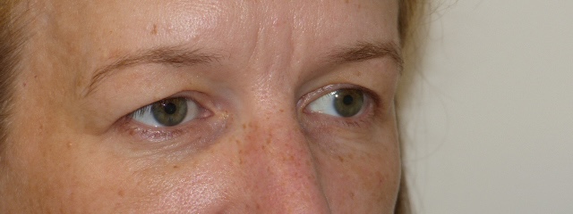 JCarn Upper Eyelid Side Before JCarn Upper Eyelid Side Before