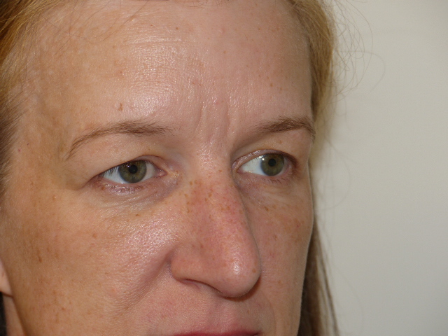 JCarn Upper Eyelid Side Before JCarn Upper Eyelid Side Before