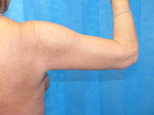 JN Branch Arm Lift After