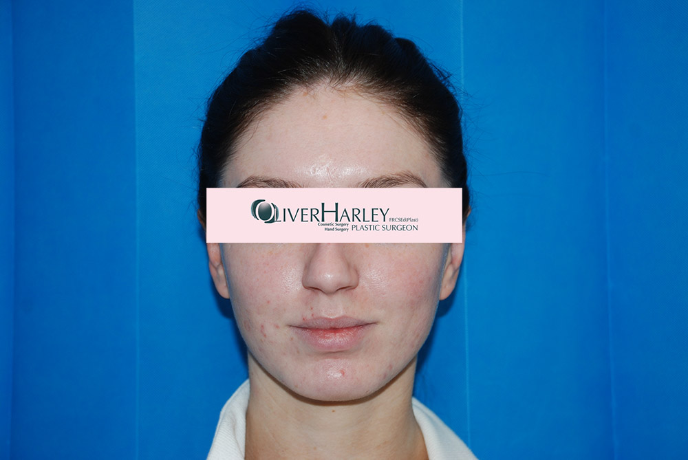 JWar Pinner Ear Correction After JWar Pinner Ear Correction After