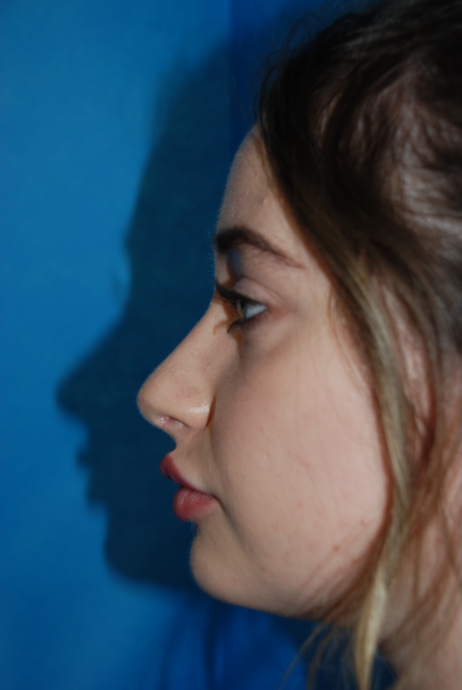 KM Rhino Nose Job After