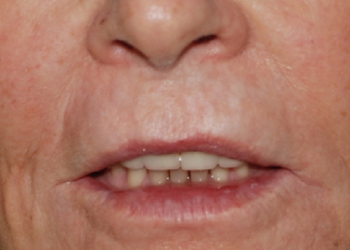 Lip treatment before