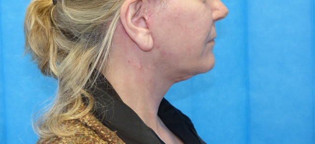 MAK KLNL Face lift side after MAK KLNL Face lift side after