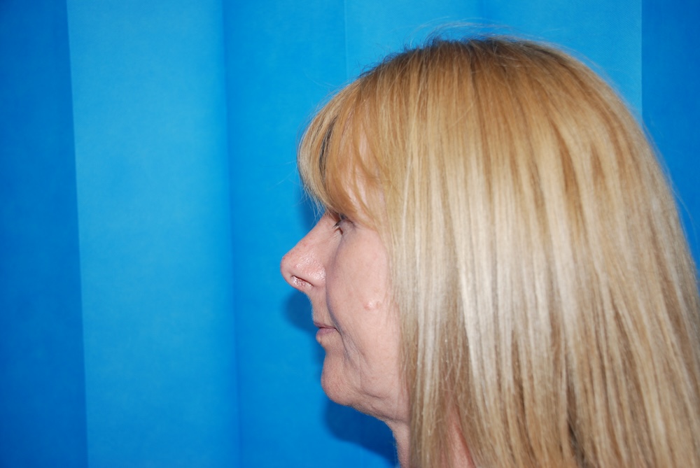 MN Rhino Nose Job After