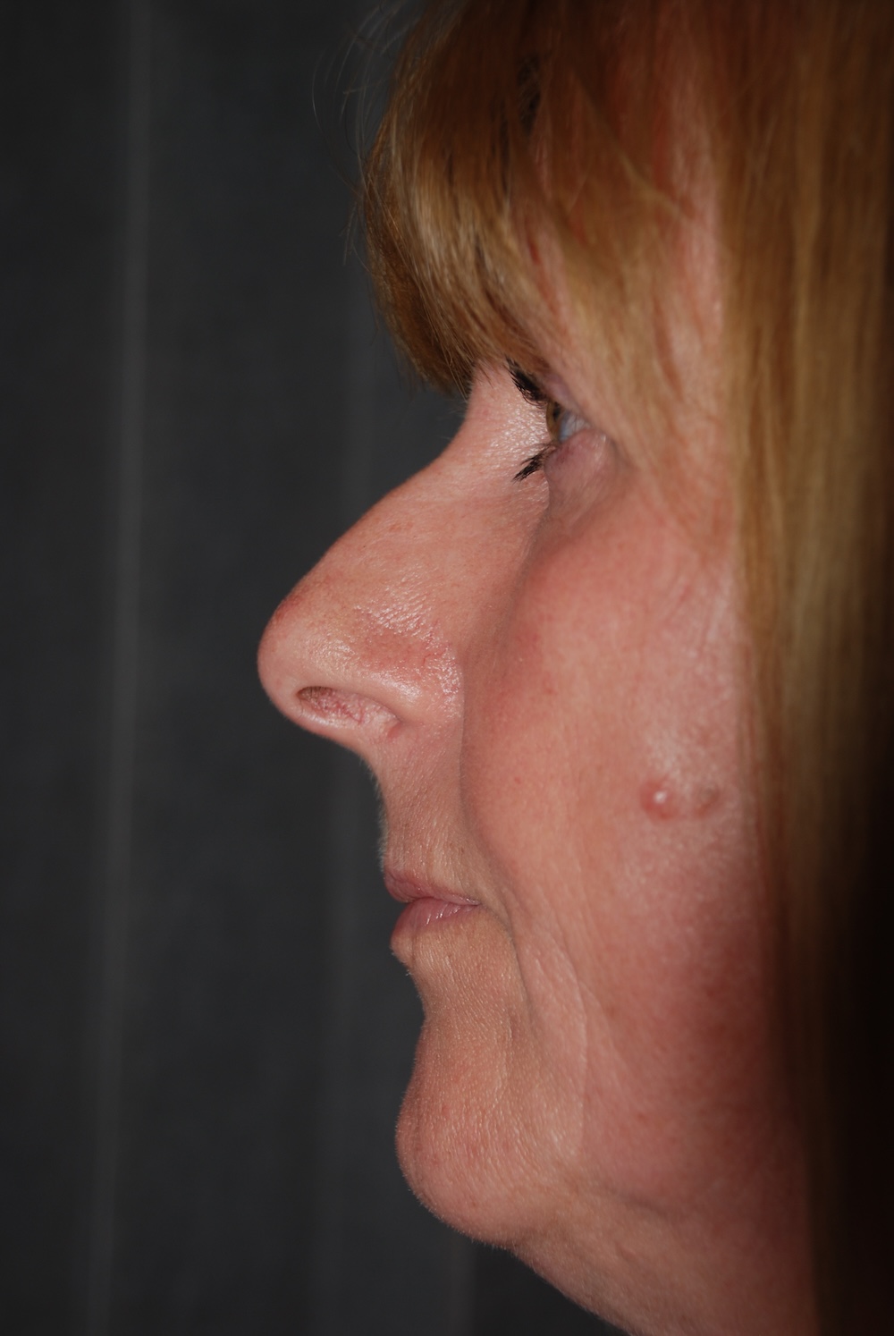 MN Rhino Nose Job Before